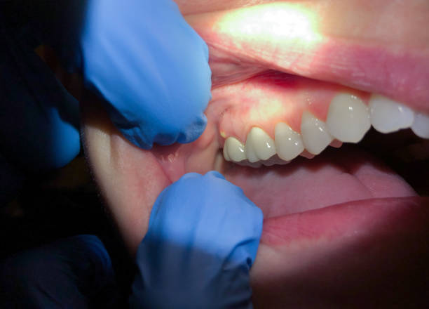 Best Knocked-Out Tooth (Avulsed Tooth) Treatment in Andrews, NC